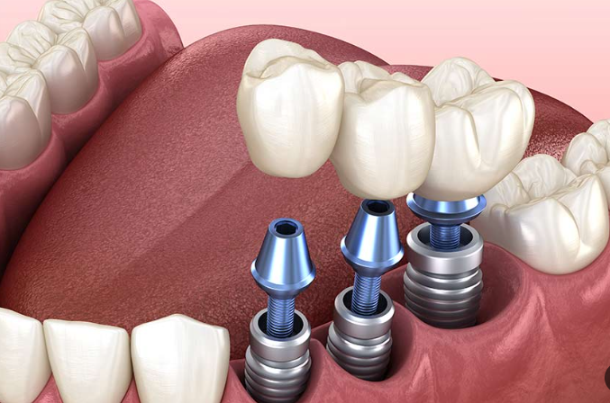 جسور على زرعات