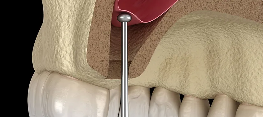 الطريقة من القمة